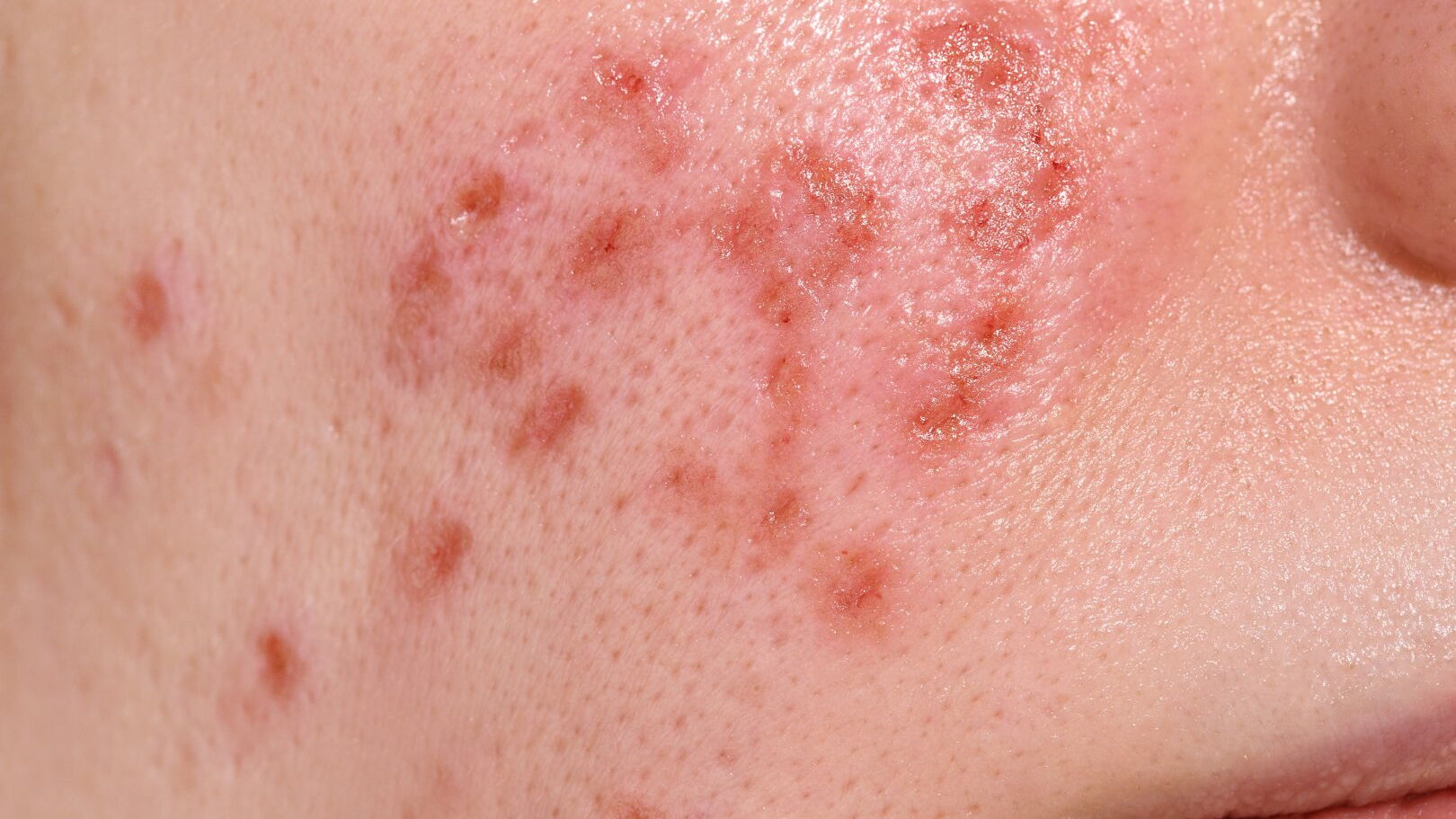 Hautheilungsphase nach einer Gesichtsbehandlung mit Erbium-Laser. Junge Frau mit Hautproblemen. Behandlung von Eispickel-Narben. Tag 1.