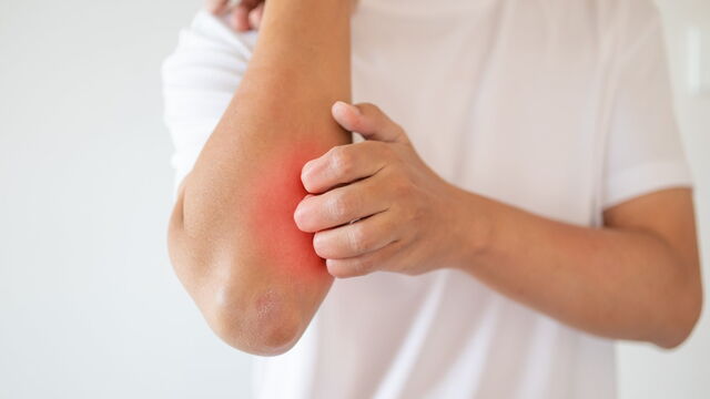 Bild zum Artikel„Hautinfektionen gezielt bekämpfen: Antibiotika-Reserven schonen“