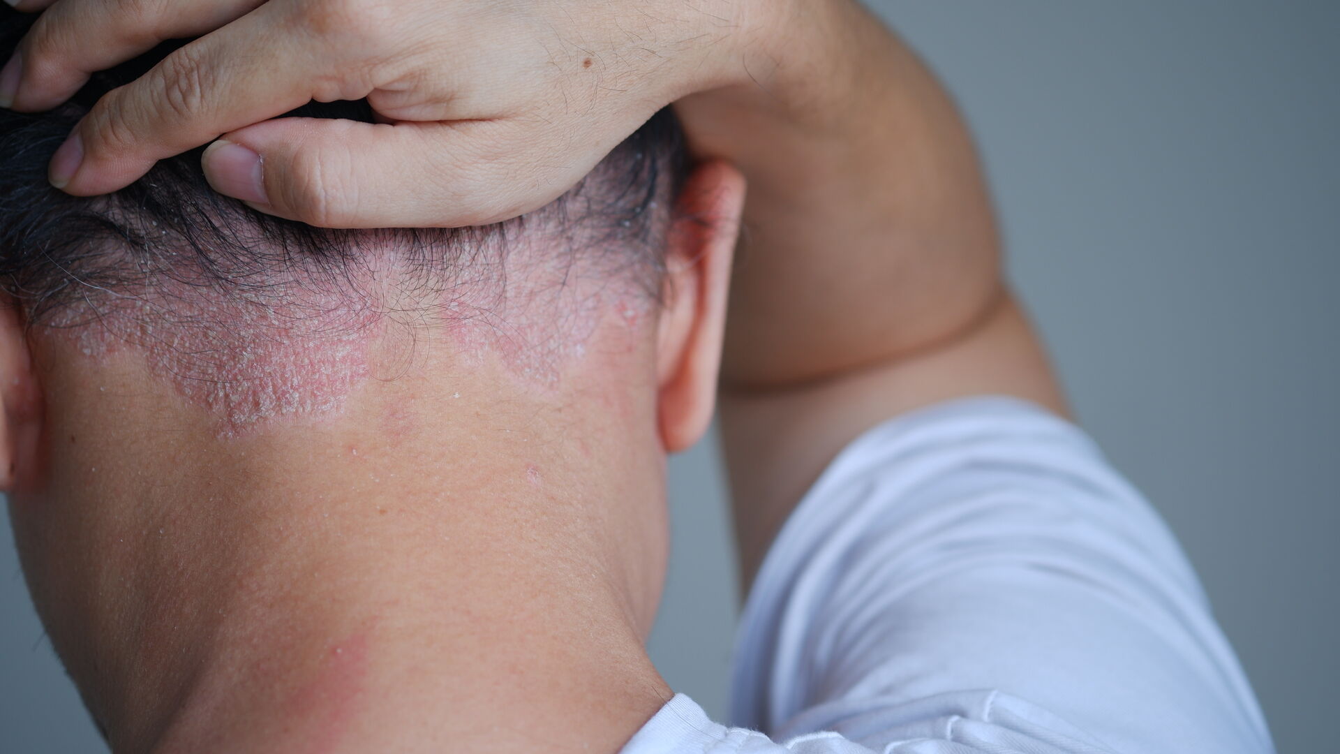 Psoriasis im Nacken eines Mannes.