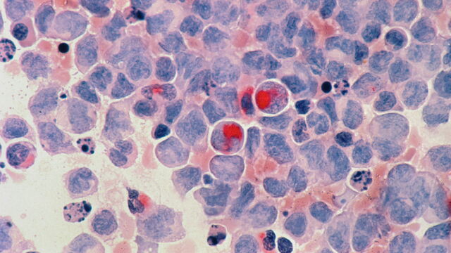 Bild zum Artikel„Revolution in der Rheumatologie: CAR-T-Zell-Therapie als Hoffnungs­träger bei schweren Autoimmun­erkrankungen“