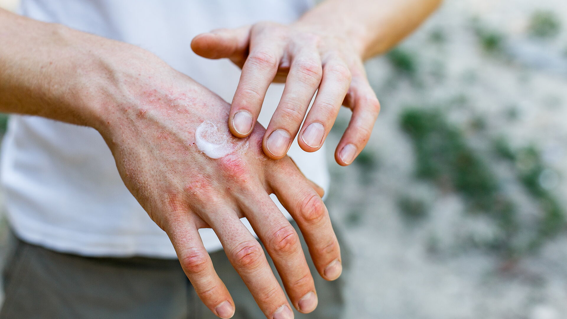 Auftragen einer rückfettenden Creme auf trockene, schuppige Haut, wie bei der Behandlung von Psoriasis, Ekzemen und anderen trockenen Hauterkrankungen. Weiße Creme auf der Haut