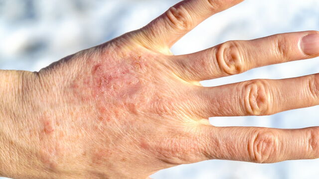 Bild zum Artikel„Handekzem: Basiscreme rettet die Therapietreue“