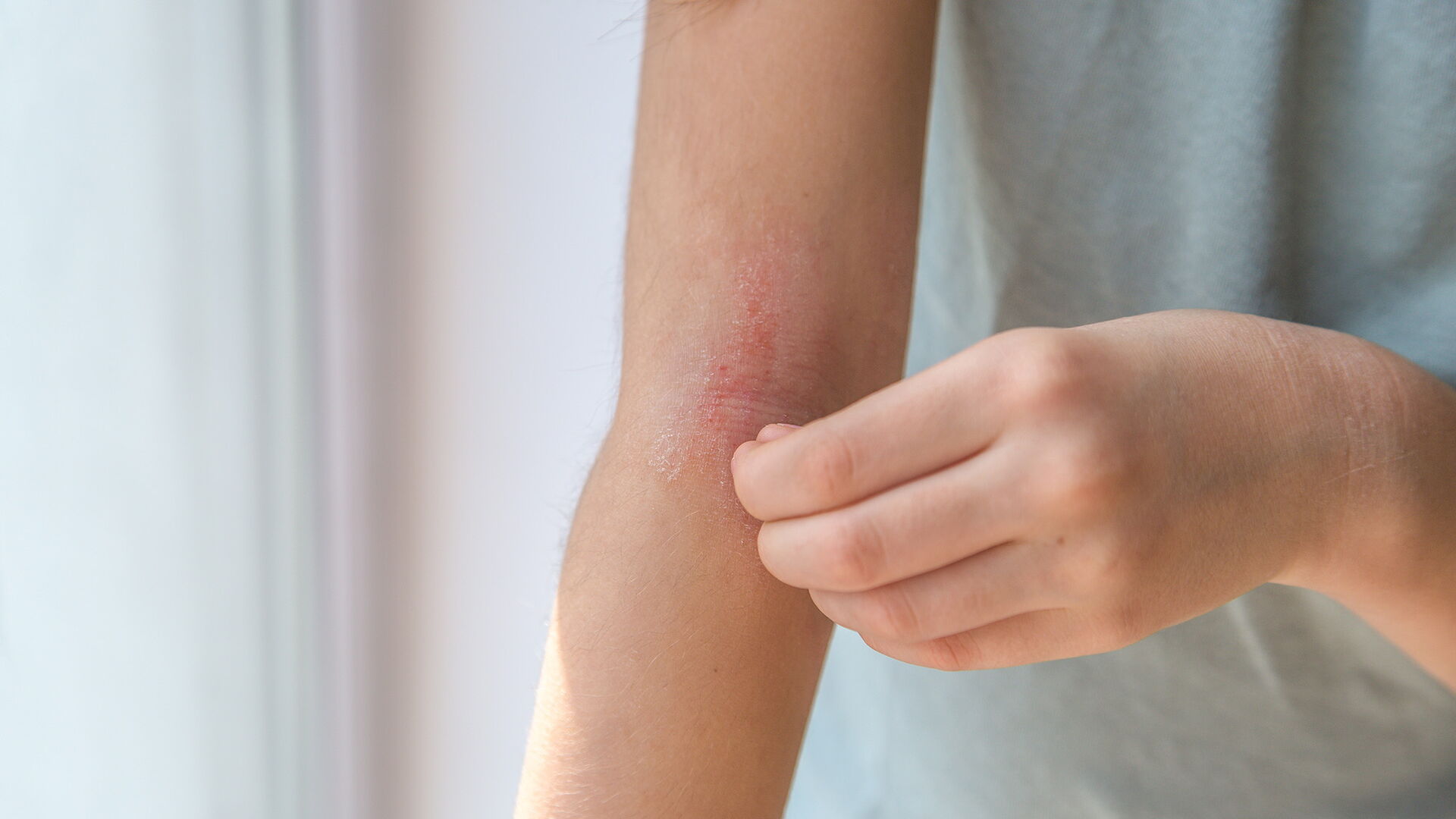 Ein Mädchen kratzt sich an der Haut am Ellenbogen ihres Arms, die Rötung ist atopische Dermatitis, das Gesicht des Mädchens ist nicht zu sehen.