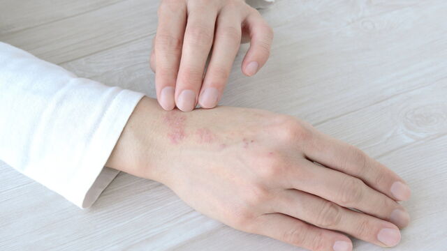 Bild zum Artikel„Panthenol plus Ceramide: Moderne Topika reparieren die Hautbarriere bei Neurodermitis“