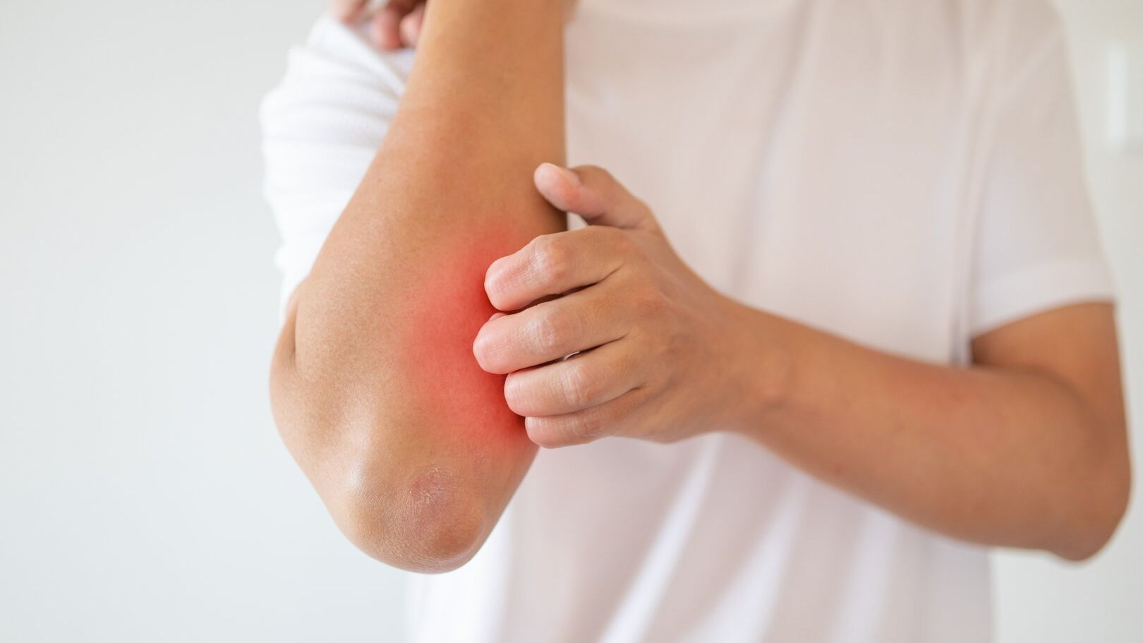 Mann kratzt sich am Arm wegen juckender, trockener Haut, Ekzem, Dermatitis