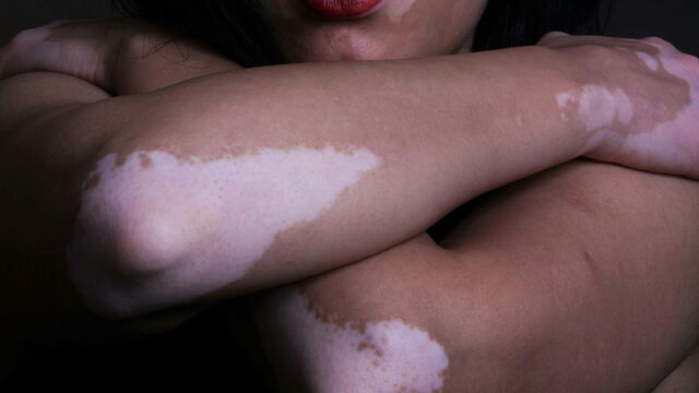 Bild zum Artikel„Vitiligo: Mehr als nur weiße Flecken“