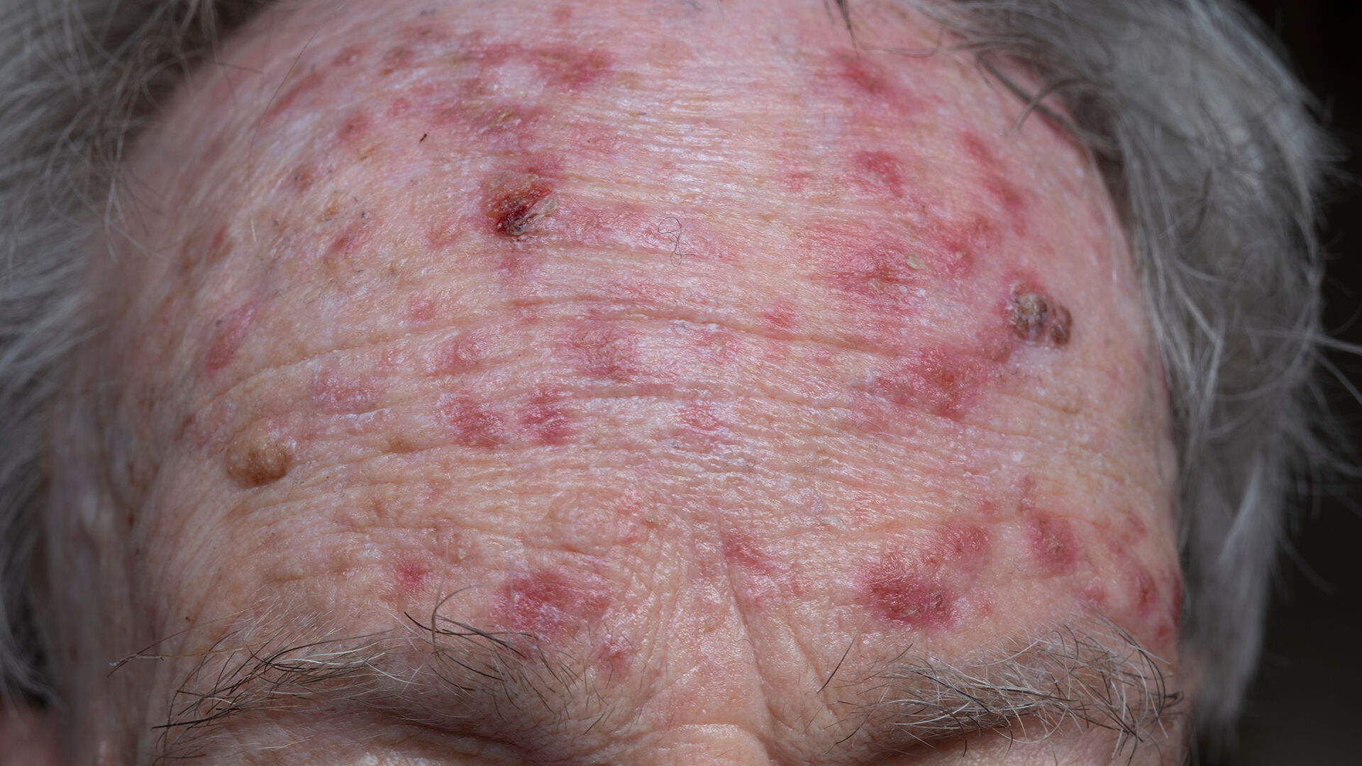 Stirn eines Mannes während der Behandlung von aktinischer Keratose mit Fluorouracil-Salbe. Rote, krustige Läsionen sonnengeschädigter Haut oder Sonnenflecken.