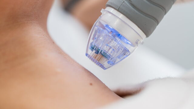 Bild zum Artikel„Wie Microneedling die Haut heilt und verjüngt“