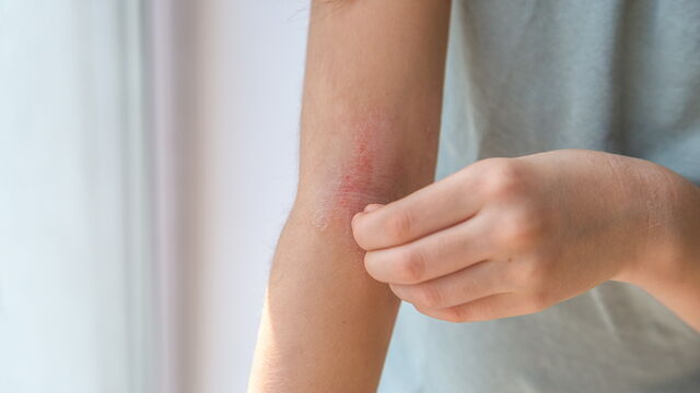 Bild zum Artikel„Hautmikrobiom und atopische Dermatitis: Therapie jenseits der Immunsuppression“
