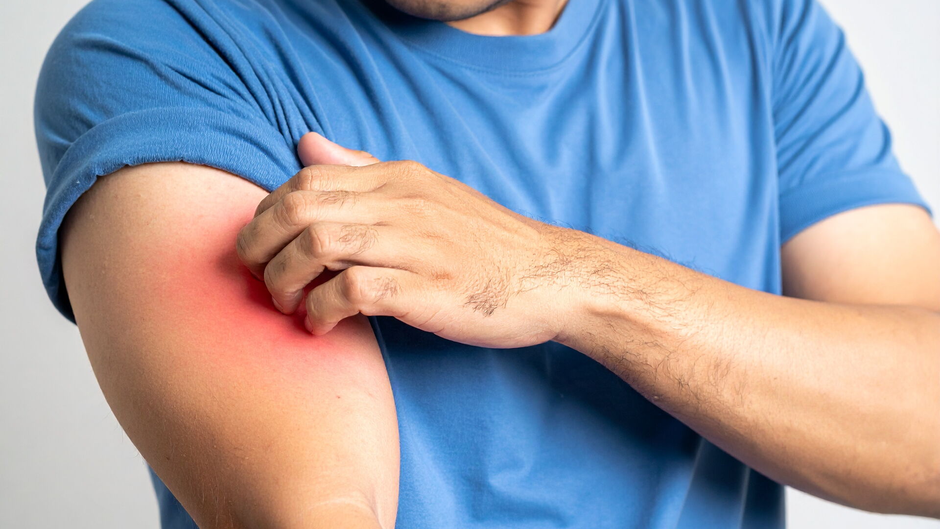 Ein Mann in einem blauen T-Shirt juckt sich am Arm, die Haut ist bereits gerötet.