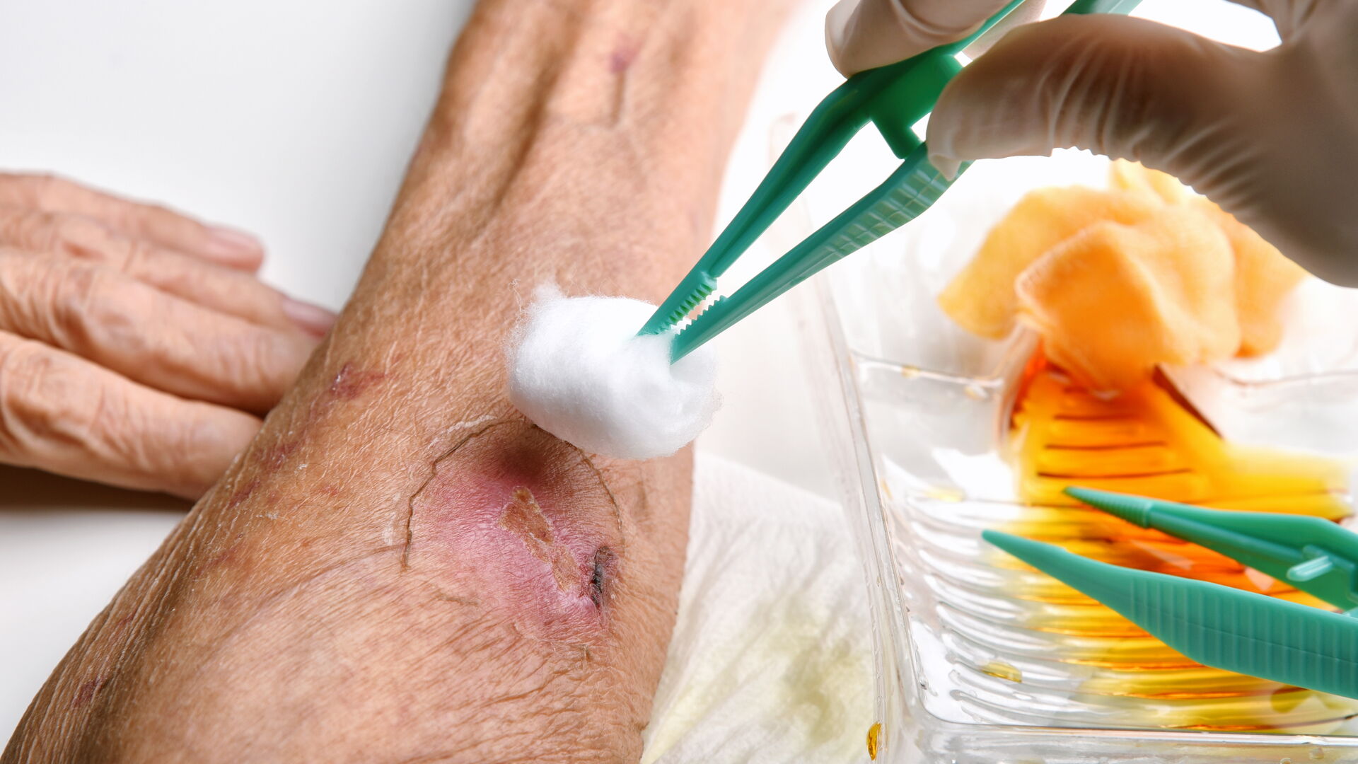 Wound dressing, Doctor cleaning and wash infected wound in chronic diabetes senior patient with normal saline and povidone iodine, Accidental wound care treatment in elderly old man
