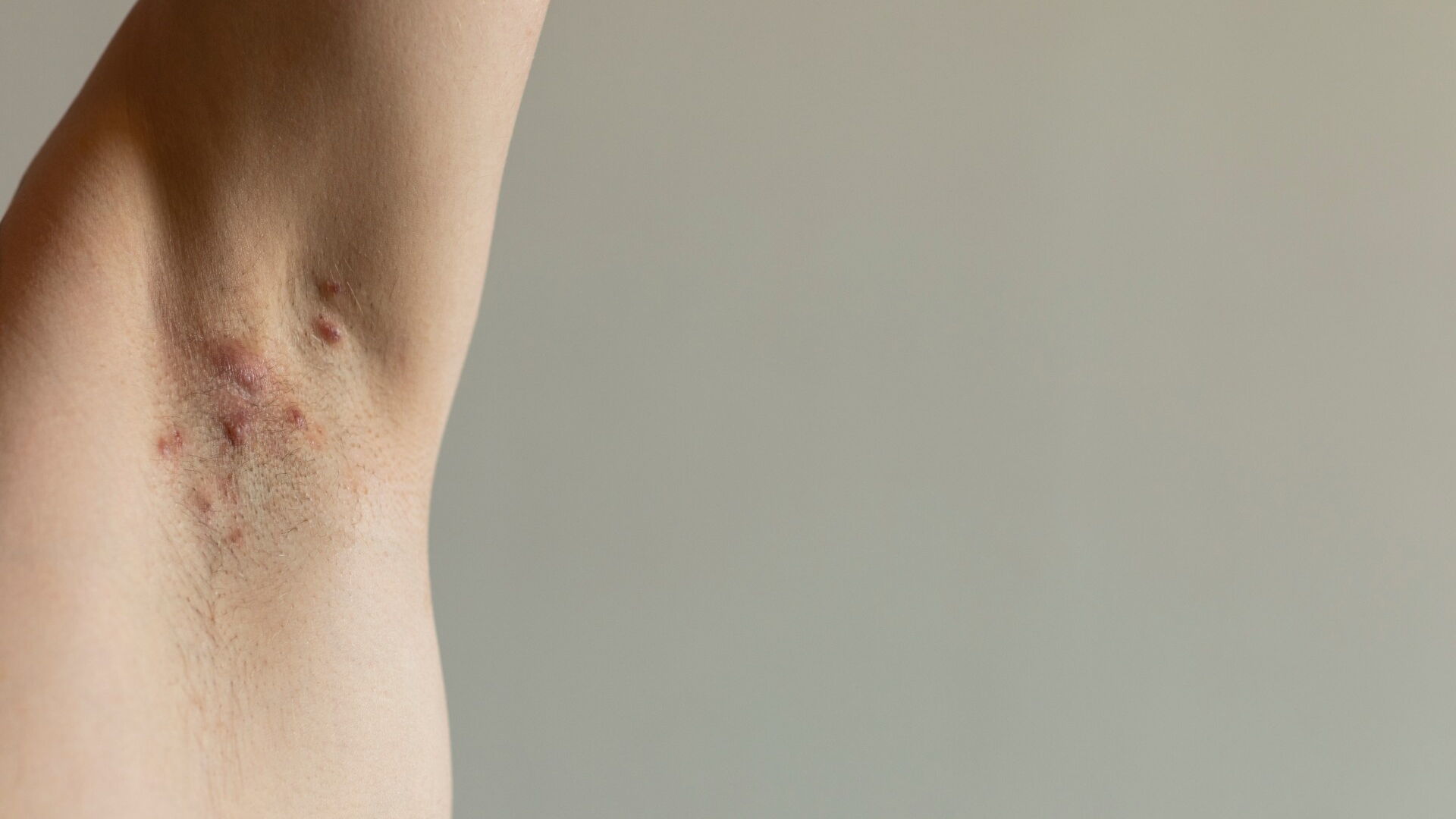 Hidradenitis suppurativa